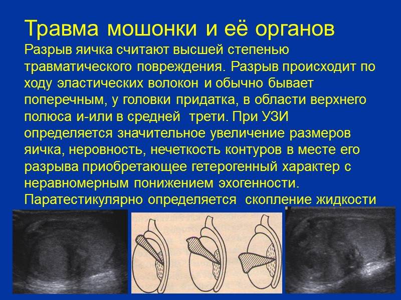 Перекрут яичка Перекрут яичка является одним из самых тяжелых острых заболеваний органов мошонки. Факторы